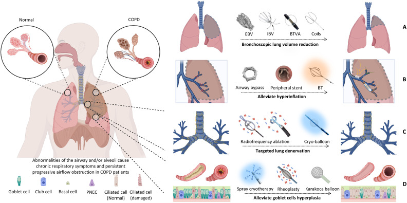 AI-Powered Urine Test Precisely Anticipates COPD Exacerbations Up to Seven Days in Advance