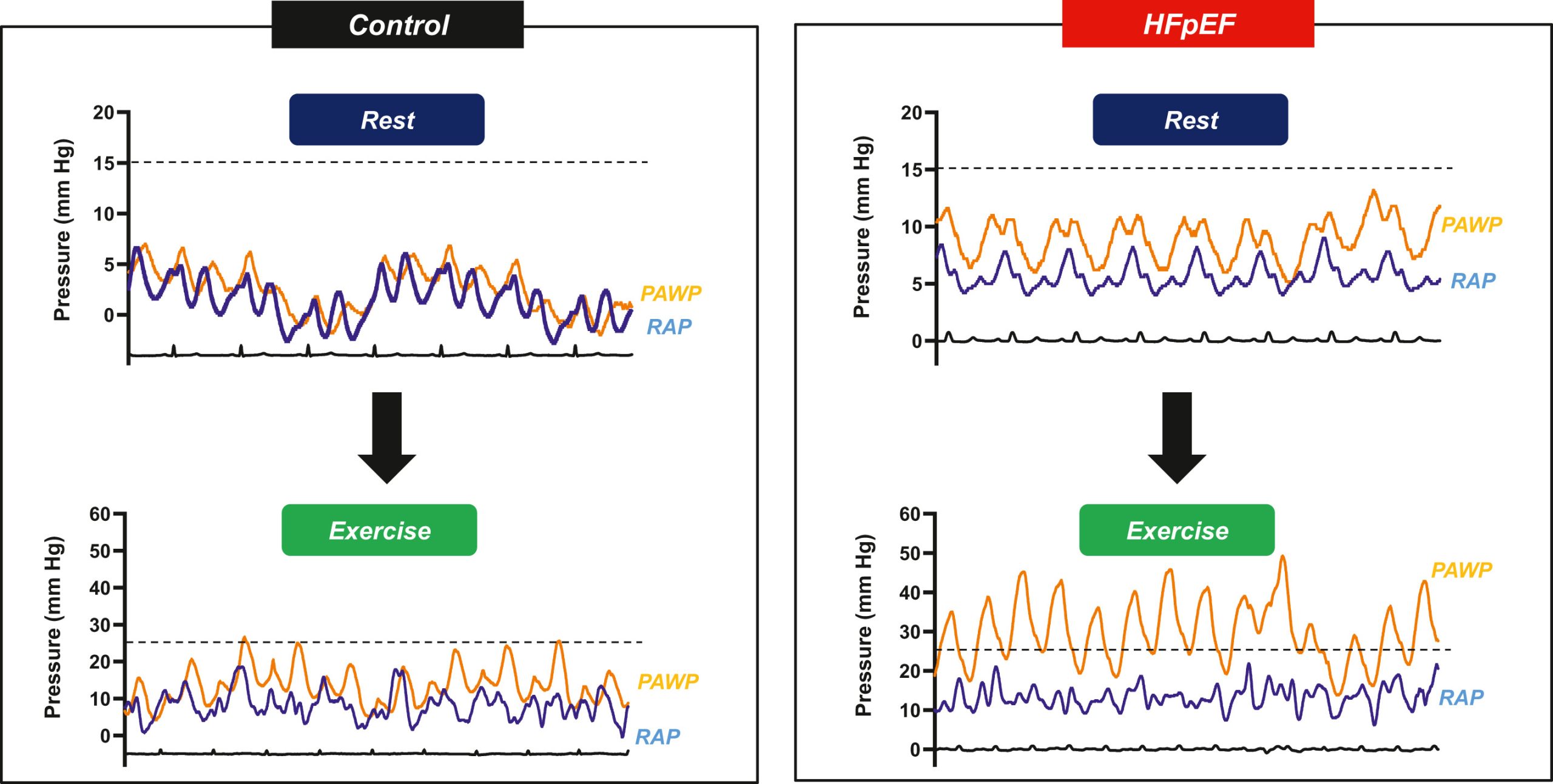 Examining the Impact of Zero Gravity on Cardiac Function in Individuals with Heart Failure and Preserved Ejection Fraction (HFpEF)