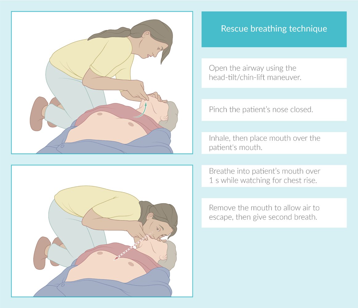 New Guidelines Emphasize the Significance of Rescue Breaths in Response to Drowning Emergencies