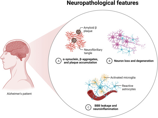 "Innovative Nanofiber-Driven Vaccine Focuses on Dementia Prevention While Reducing Inflammation"