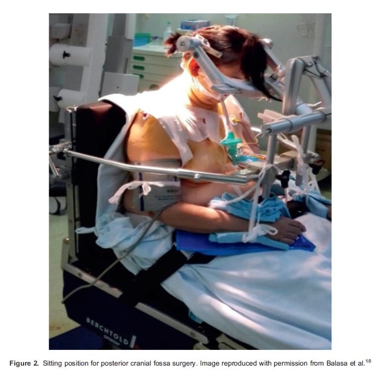 Brain Monitoring Substantially Lowers Anesthesia Needs During Surgery