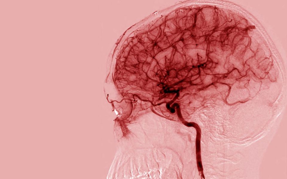 Consistent Midlife Physical Activity May Aid in Safeguarding the Brain Against Alzheimer’s Disease