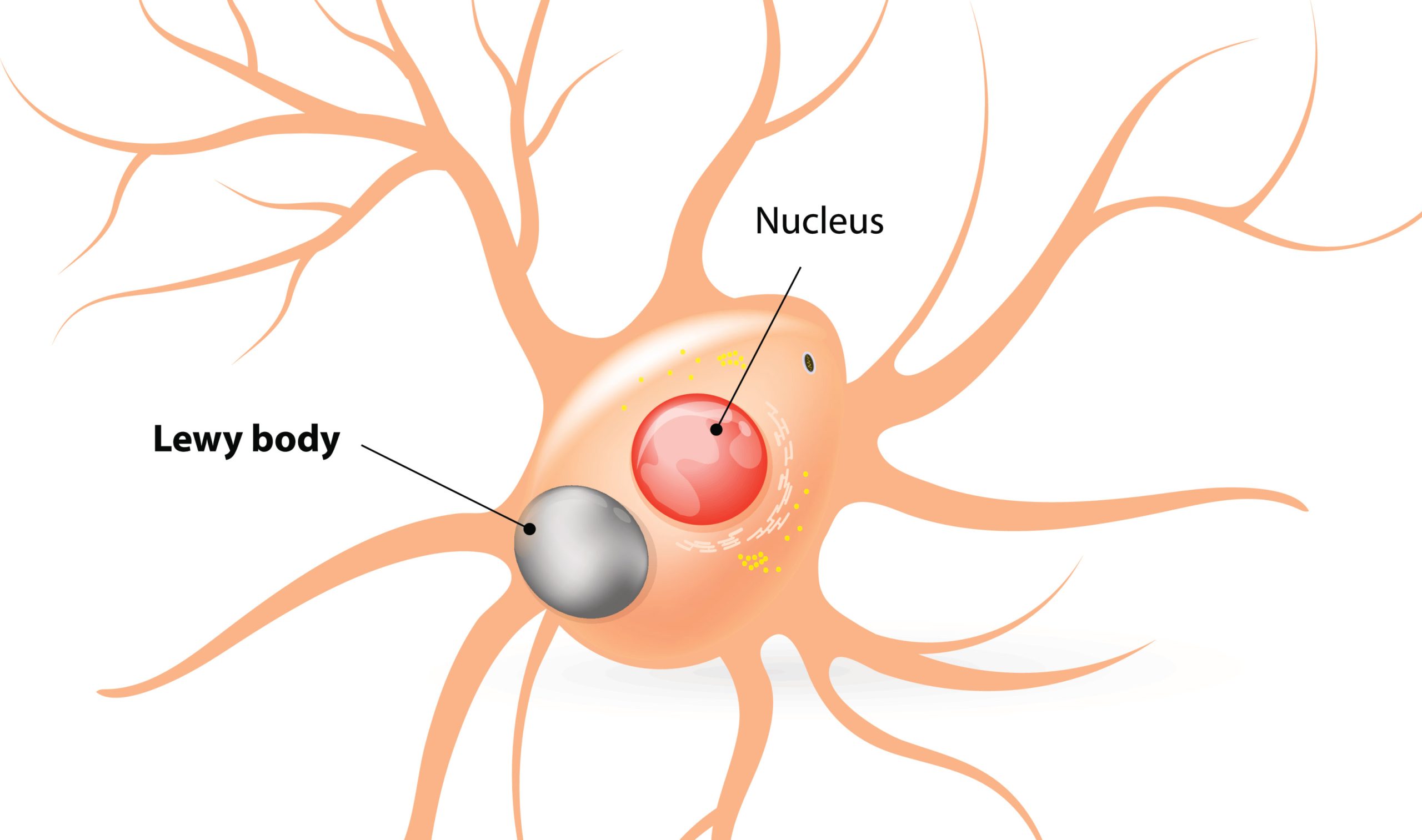 Alzheimer’s Disease Might Affect the Whole Body, Not Only the Brain