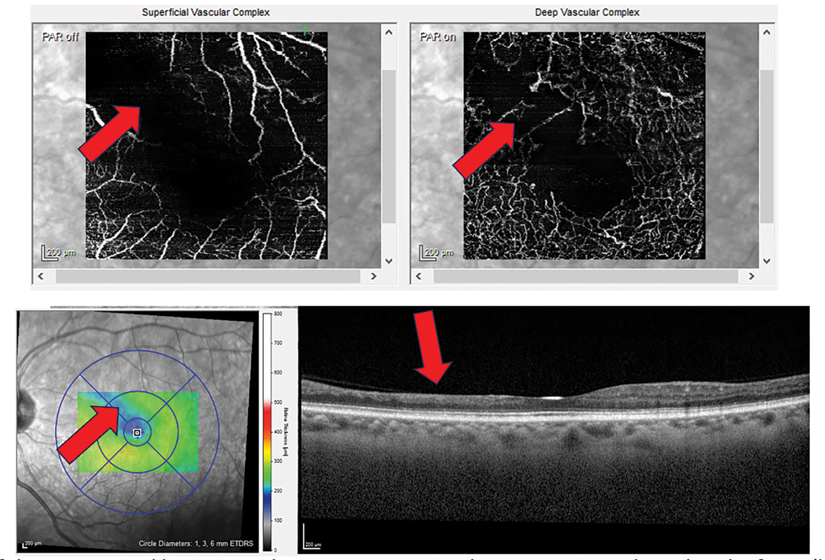 Eye Exam Identifies Early Parkinson's Disease Prior to Symptom Onset