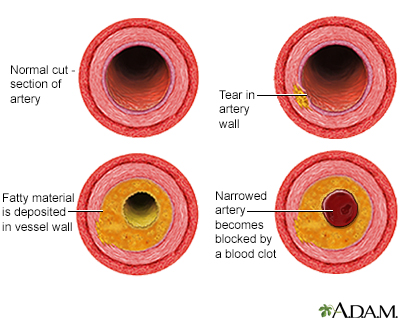 Concealed Abdominal Fat Harms Arteries in Well Adults