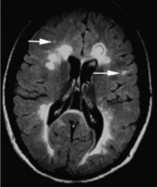 Multiple Sclerosis Inflicts Brain Damage Seven Years Prior to Diagnosis