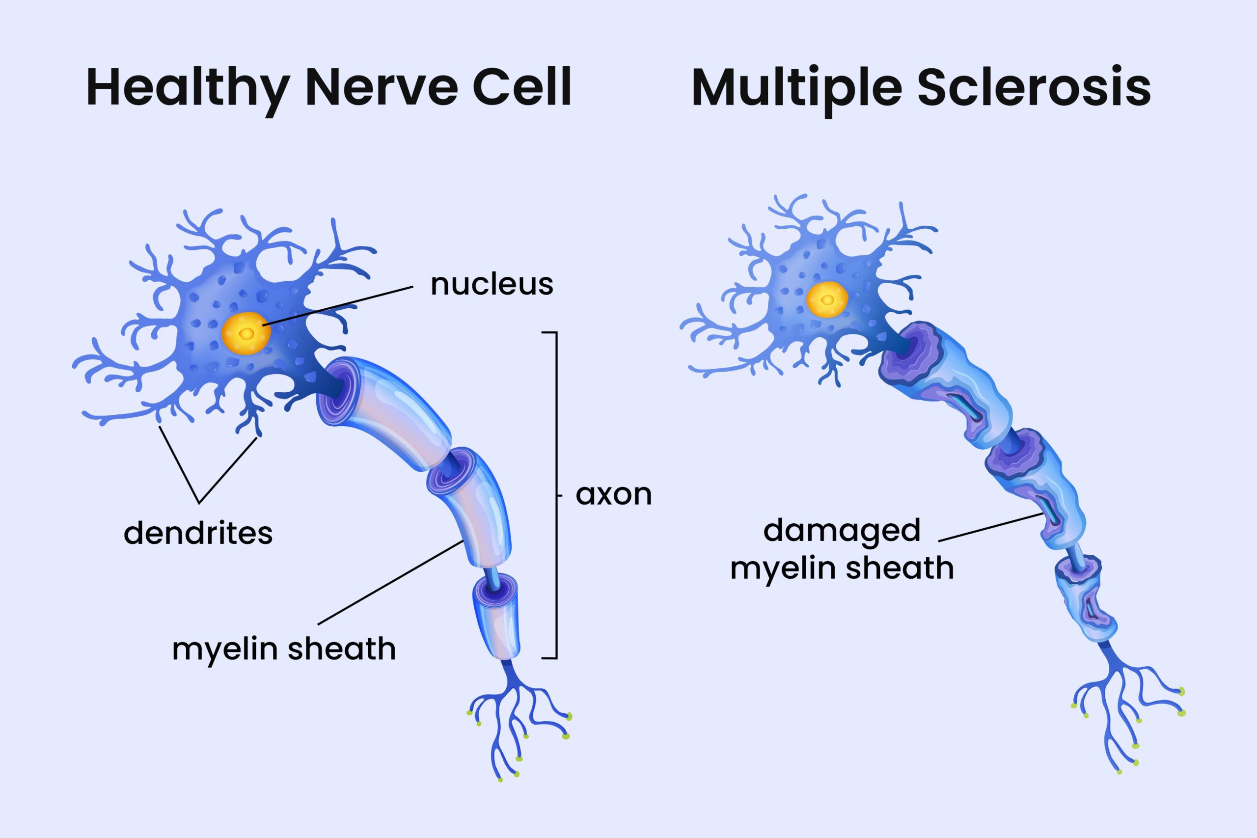 The Possible Involvement of a Shared Virus in Initiating Multiple Sclerosis