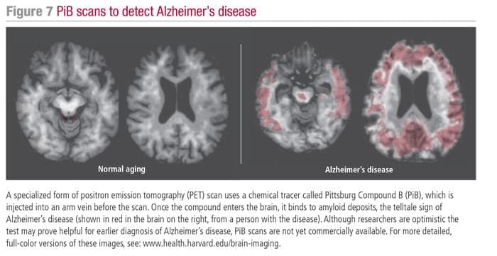 A Blood Examination for Identifying the Advancement of Alzheimer’s Disease