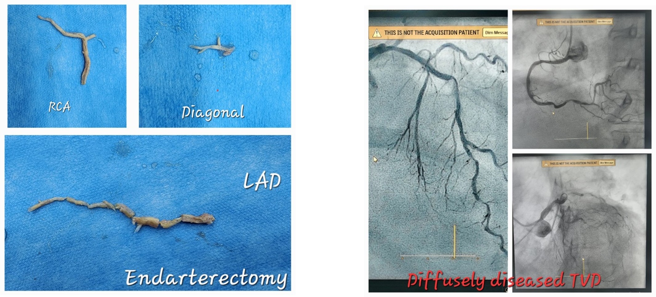 The Unnoticed Variation Amplifying Risk in Cord Blood Transplants by Three Times