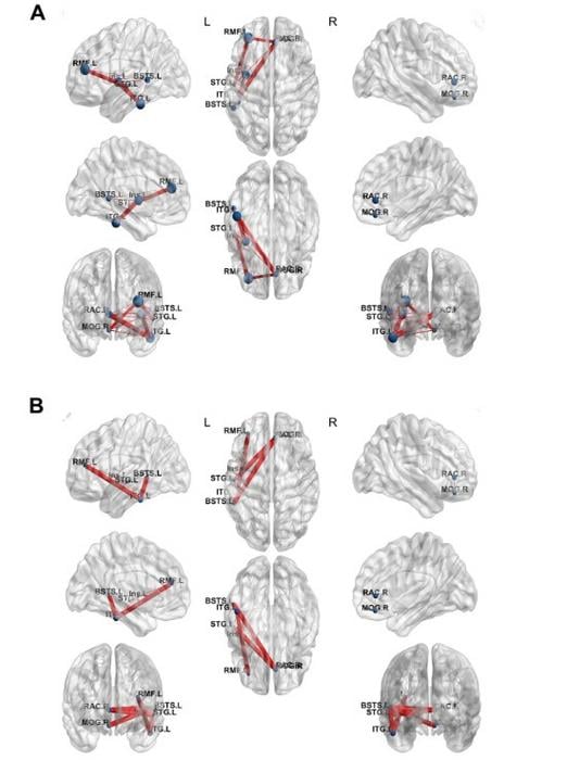 Heat Treatment for Epilepsy Alters Neural Networks: An Examination of Its Efficacy