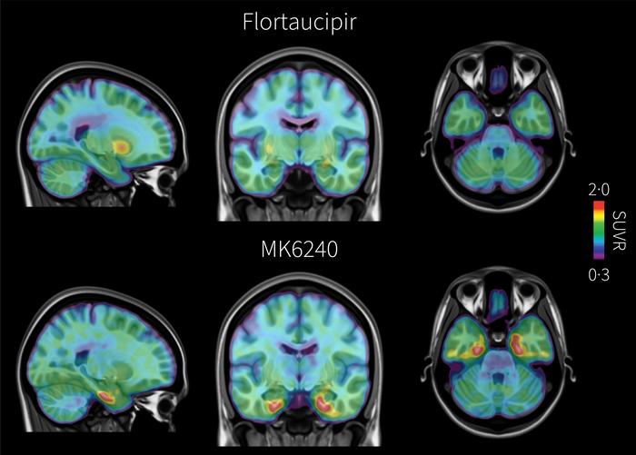 Sophisticated Brain Imaging Identifies Alzheimer's Tau Years Prior to Symptoms, Increasing Early Diagnosis Rates Twofold