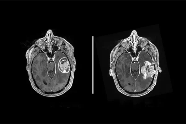 Testosterone Shown to Suppress Brain Tumor Development, Challenging Established Cancer Theory