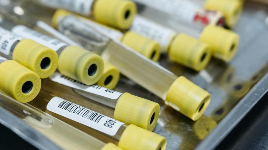 Urine Examination Identifies Autism in Kids by Analyzing Gut Microbes