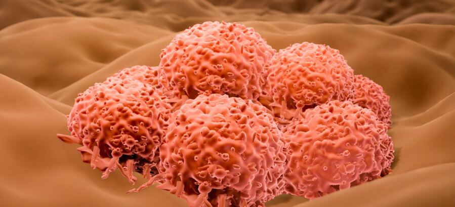 Customized Tumor-Based Vaccine Remains Effective in Suppressing Melanoma Advancement After Five Years
