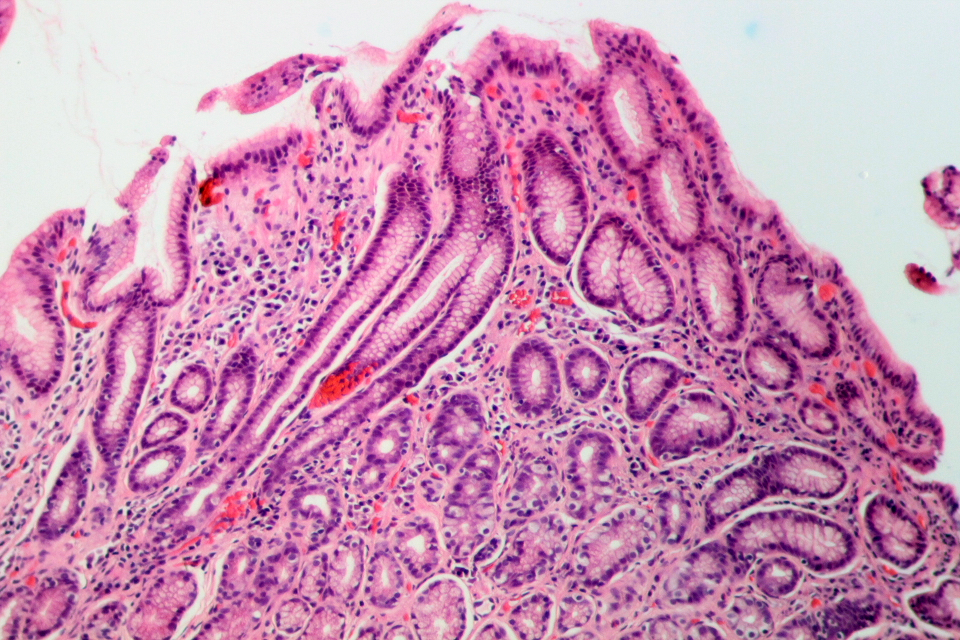 Australian physician demonstrates that bacteria are responsible for gastritis through self-experimentation, resulting in a Nobel Prize for ulcer research two decades later.